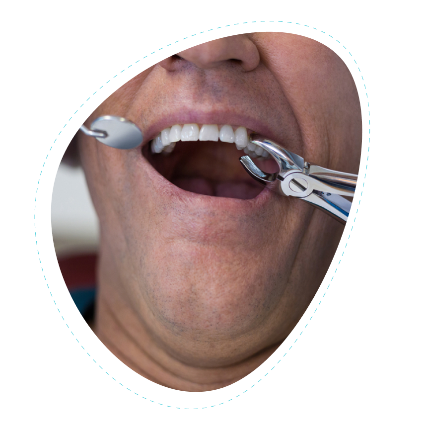 tooth extraction service in Flower Mound tx